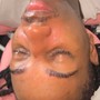 Acne Facial