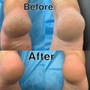 Foot Paraffin treatment