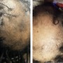 Dandruff Scalp Treatment