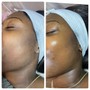 Diamond Microdermabrasion ( add on ONLY)