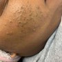 Microdermabrasion