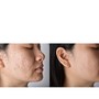 MicroNeedling