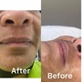 High Frequency Facial