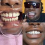 Teeth whitening + 2 Tooth Gems