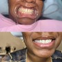 Teeth whitening + 2 Tooth Gems