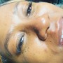 Chemical  Peel