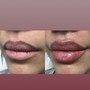 Lips fillers