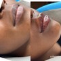 Lips fillers