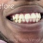 2 Year Coverage Sparkling Halo Veneers in-house Insurance (maintenance/ chips/ broken or missing veneers)