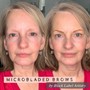 MicroNeedling *add LED therapy for $25