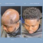 DAPPER 4-6 Month Non Surgical Cranial Prosthesis Service