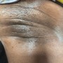 Microdermabrasion