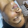 Dermaplaning