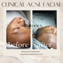 Clinical Acne Facial