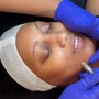 Skincare Consultation, Chemical peel