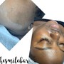 Acne Facial