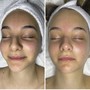 Microdermabrasion