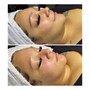 Microdermabrasion