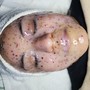 Microdermabrasion