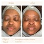 Chemical peel -Lighten Peel