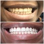 60 Minute Teeth Whitening