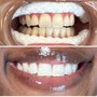 60 Minute Teeth Whitening