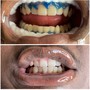 60 Minute Teeth Whitening