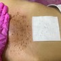 Microdermabrasion