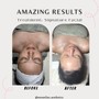 Dermaplane Facial