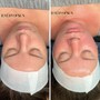 Hydrafacial Keravive Treatment