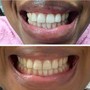 Teeth Whitening