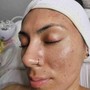 ACNE FACIALS