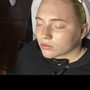 Microdermabrasion W/ Extractions