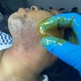 Chin Sugaring