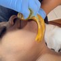 Chin Sugaring