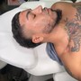 Micro-needling (Hair restoration)