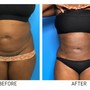 3Treatments Laser Lipo + Cavitation + tightening