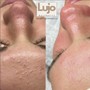 Dermaplaning Facial