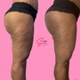 1 Cellulite Reduction Session