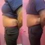 1 Cellulite Reduction Session