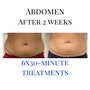 30 min Fat Cavitation on one area