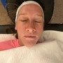 Chemical Peel