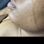 Dermaplane facial