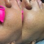 Dermaplane facial