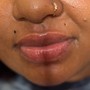 Needle Less lip Filler