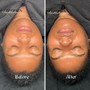 Hydrafacial Keravive Treatment