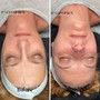 Microdermabrasion