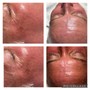 Acneic Chemical Peel