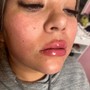 Needle Less lip Filler