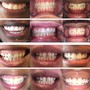 30 min Zoom Teeth Whitening